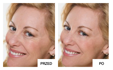 botox_2