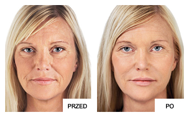Efekty przed i po mezoterapii skóry twarzy w okolicach czoła u kobiety.