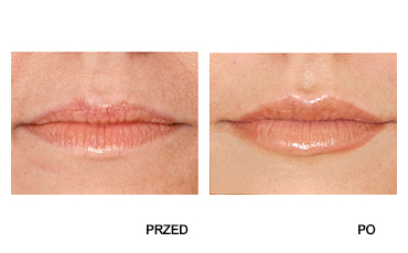Efekt zastosowania zabiegu mezoterpaii na ustach u kobiety.
