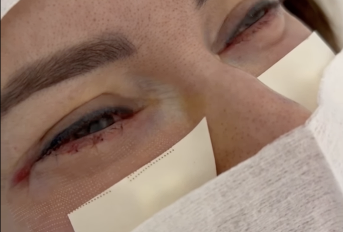 Jak goi się rana po plastyce powiek? Pełny przebieg rekonwalescencji krok po kroku