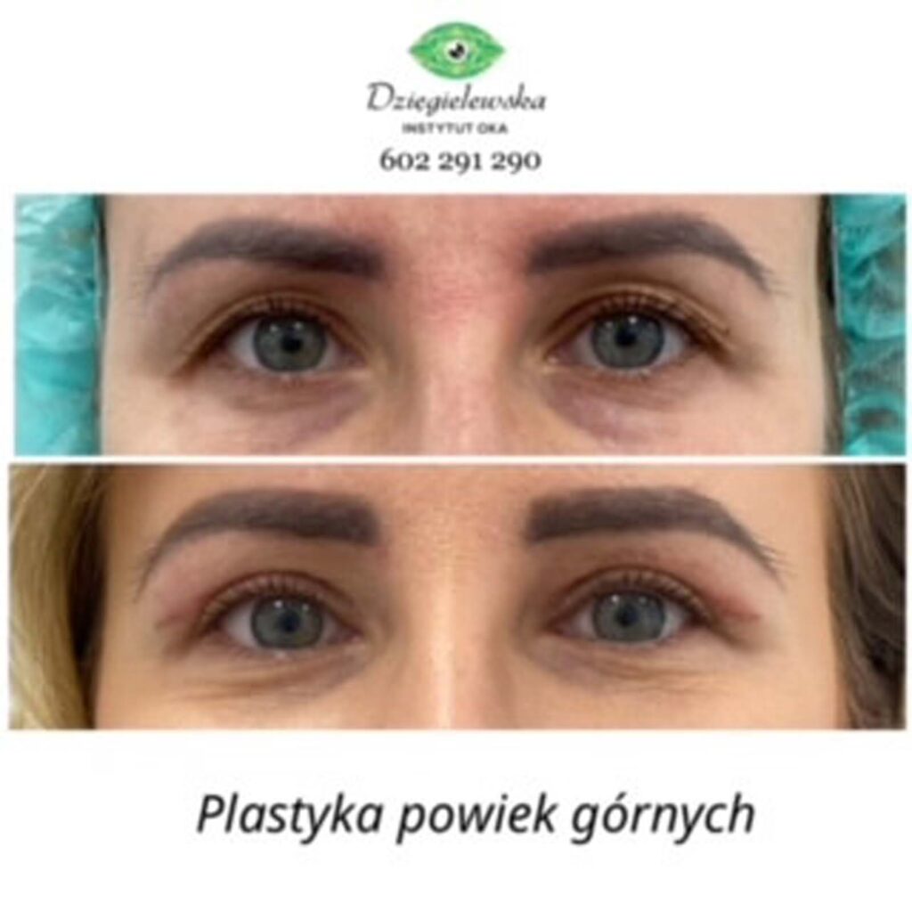 Rezultaty po plastyce powieki górnej