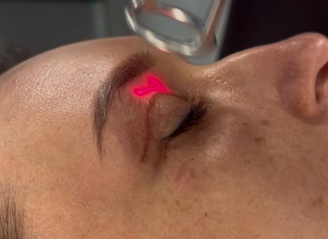 Blizna hiperpigmentacyjna po zabiegu – czym jest i jak ją leczyć?