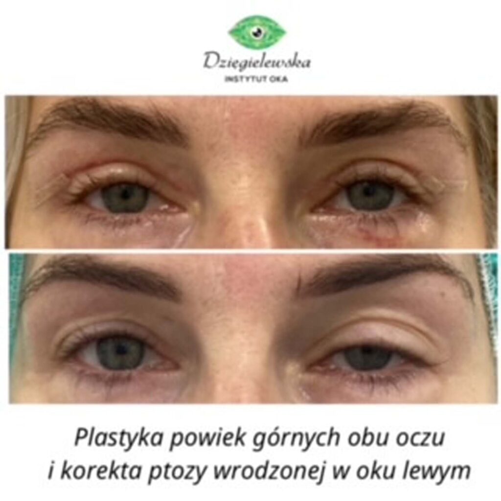 blefaroplastyka powiek dolnych